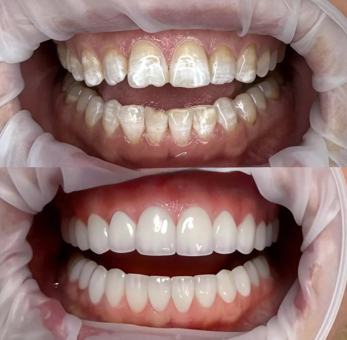 Full transformation: before treatment, the teeth showed widespread discoloration and surface staining across both arches; after treatment, comprehensive ceramic restorations delivered a bright, uniform, and naturally vital smile.